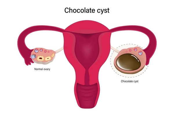 chocolate cyst treatment in jayanagar 4th Block